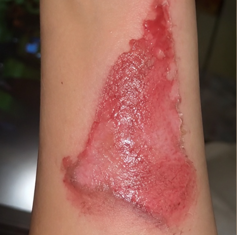 Before - Stressed-looking skin after heat exposure