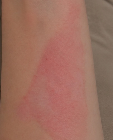 After - Stressed-looking skin after heat exposure