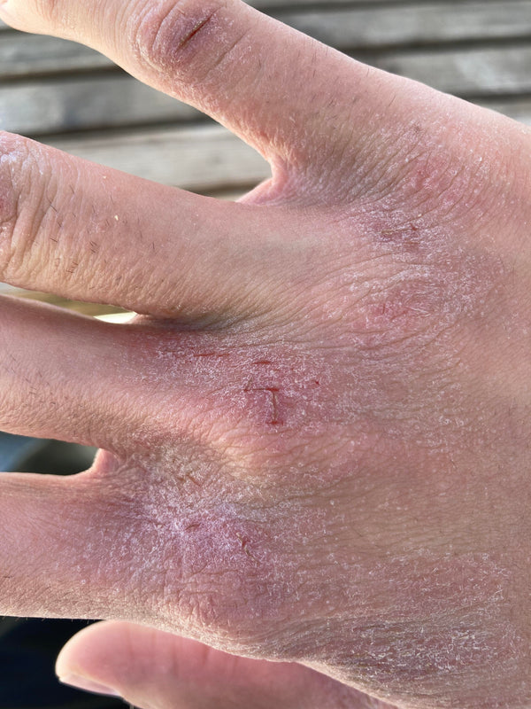 Before - Very dry, rough skin