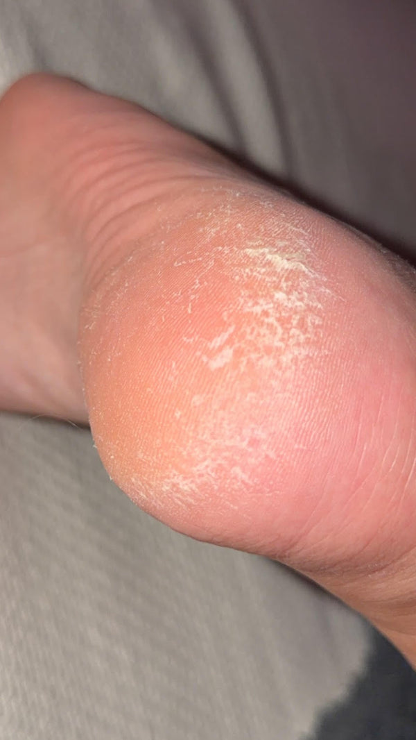 Before - Dry, cracked heel
